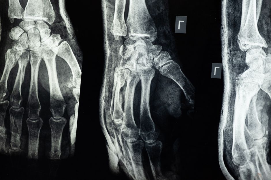 Top 10 Secrets About Bone Density
